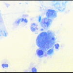 Αδενικά κύτταρα με διογκωμένους υπερχρωματικούς πυρήνες 